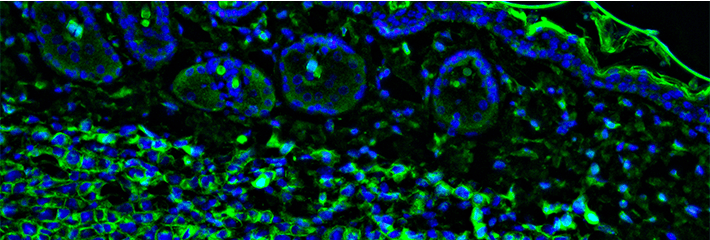 Tumour immunofluorescence IHC image. Aggressive metastatic Melanoma Tumor cells in green with blue nuclei invading into the skin.