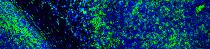 Tumour immunofluorescence IHC image of immunotherapy treatment. Tumor cells in blue attacked by immune system T cells lymphocytes in green